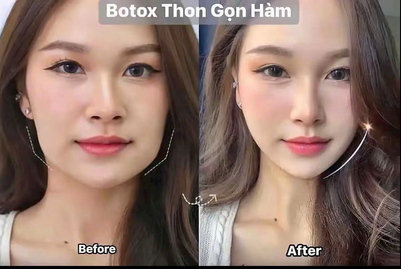 Tiêm gọn hàm 